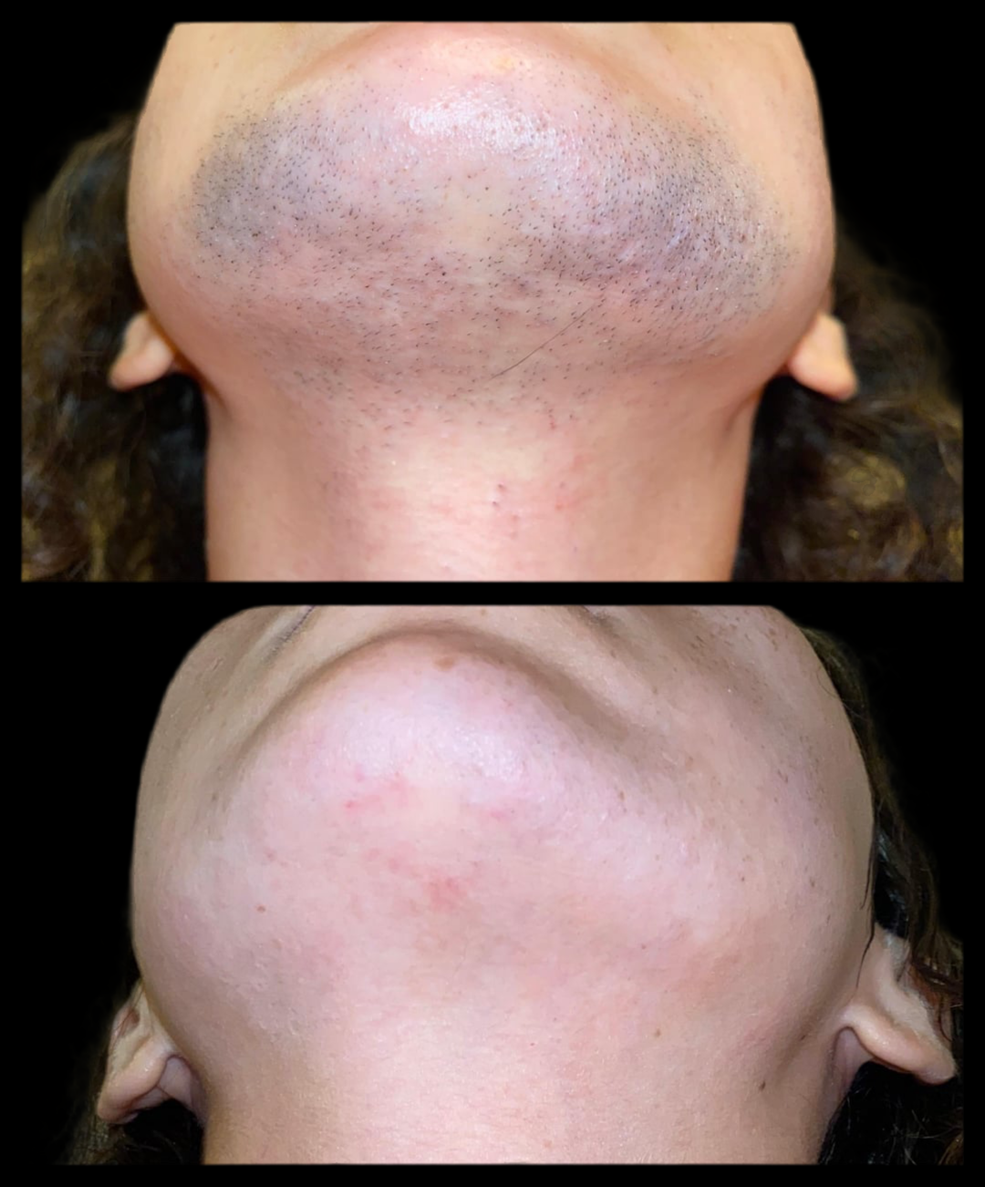SilkSmooth™ IPL Hair Removal Device