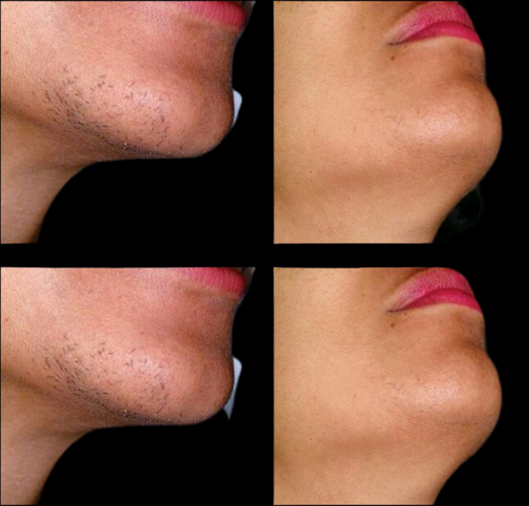 SilkSmooth™ IPL Hair Removal Device