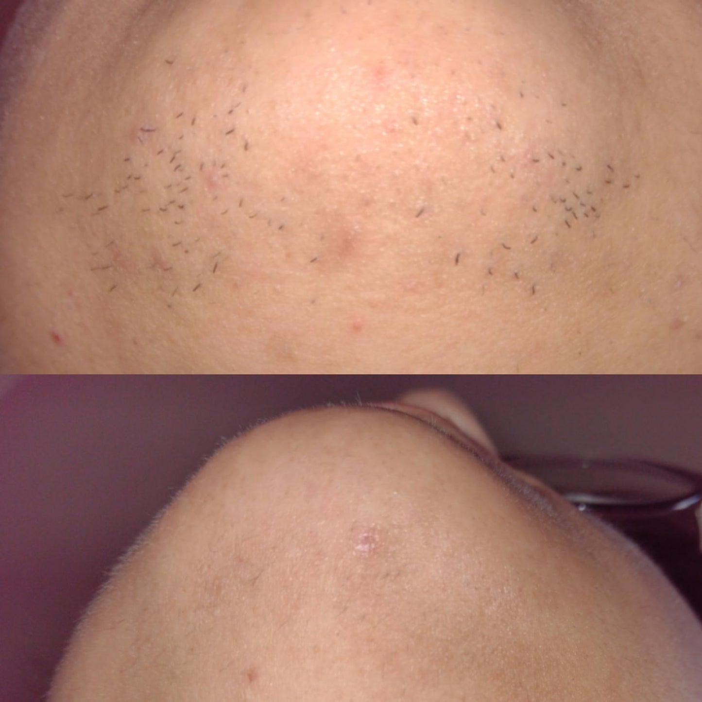 SilkSmooth™ IPL Hair Removal Device